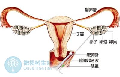 患有妇科炎症，对泰国试管婴儿周期有影响吗？