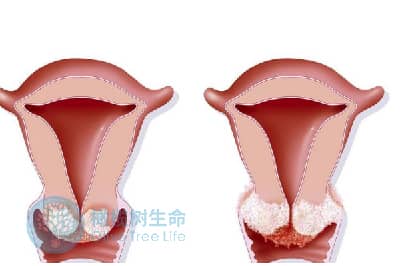 宫颈囊肿去泰国做试管婴儿是否需要先处理？