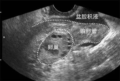 盆腔积液去泰国做试管婴儿要注意什么？