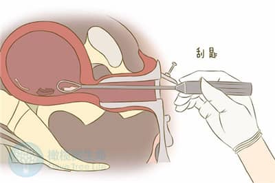子宫内膜薄会剥夺生育权吗?对此您会怎么看?