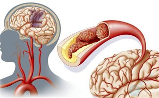 抗磷脂综合征做试管，会遗传给宝宝吗？如何健康生育？