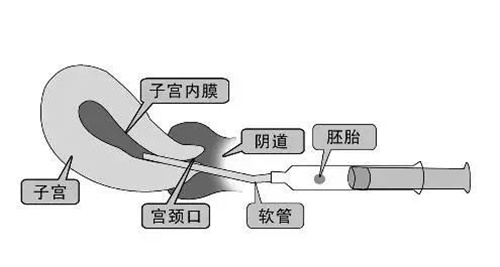 保证试管婴儿成功率大化的九个因素！